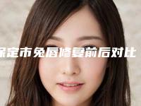 保定市兔唇修复前后对比价格(价目)表全新呈现(2025年均价为：71990元）
