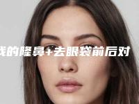 我的隆鼻+去眼袋前后对比图