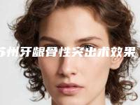 苏州牙龈骨性突出术效果能保持多久